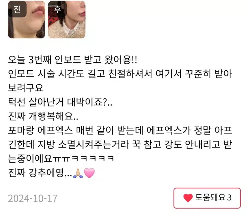 서초구 플래너성형외과의원 V라인 인모드 4만원 후기 추천