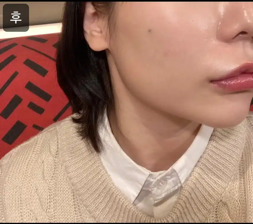 서초구 플래너성형외과의원 V라인 인모드 4만원 후기 추천