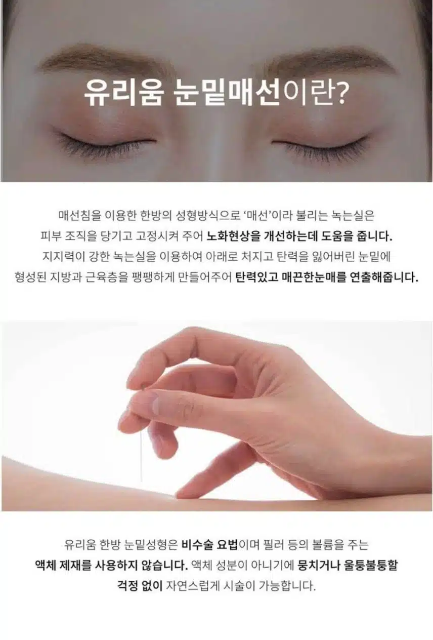 송파구 유리움 한의원 눈밑 매선 추천후기