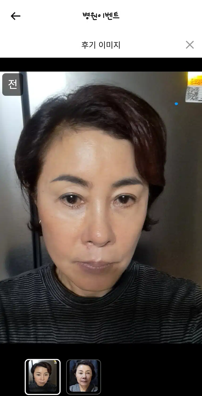 서초 미케이의원 잡티지우개 에이톤레이저 9.9만 후기 추천해요