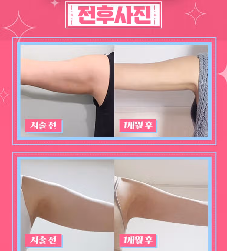 강남 아이유클리닉 팔뚝분해주사 후기 추천해요👍