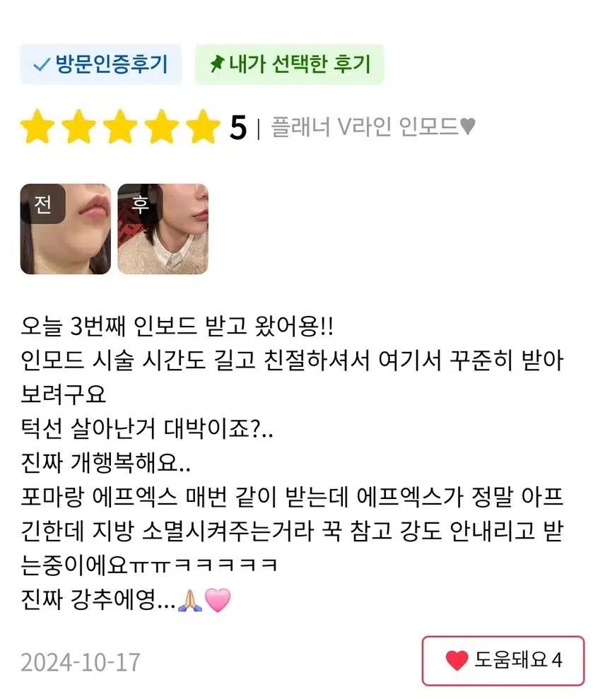 강남 서초구 플래너 V라인 인모드 4만원 후기!!