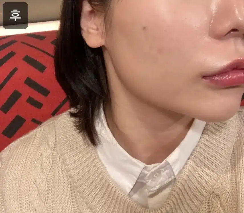 강남 서초구 플래너 V라인 인모드 4만원 후기!!