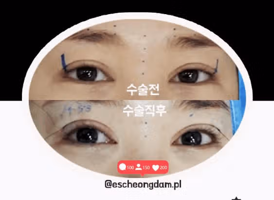 서울 강남구 이에스청담 ES🔺쌍꺼풀끝라인올리기 후기 추천