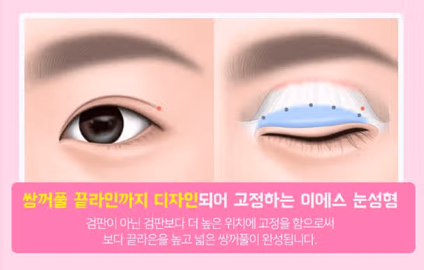 서울 강남구 이에스청담 ES🔺쌍꺼풀끝라인올리기 후기 추천