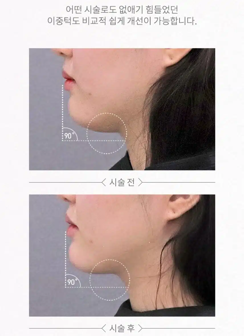 일산 V라인 만드는 인모드 리프팅 6.5만원 후기