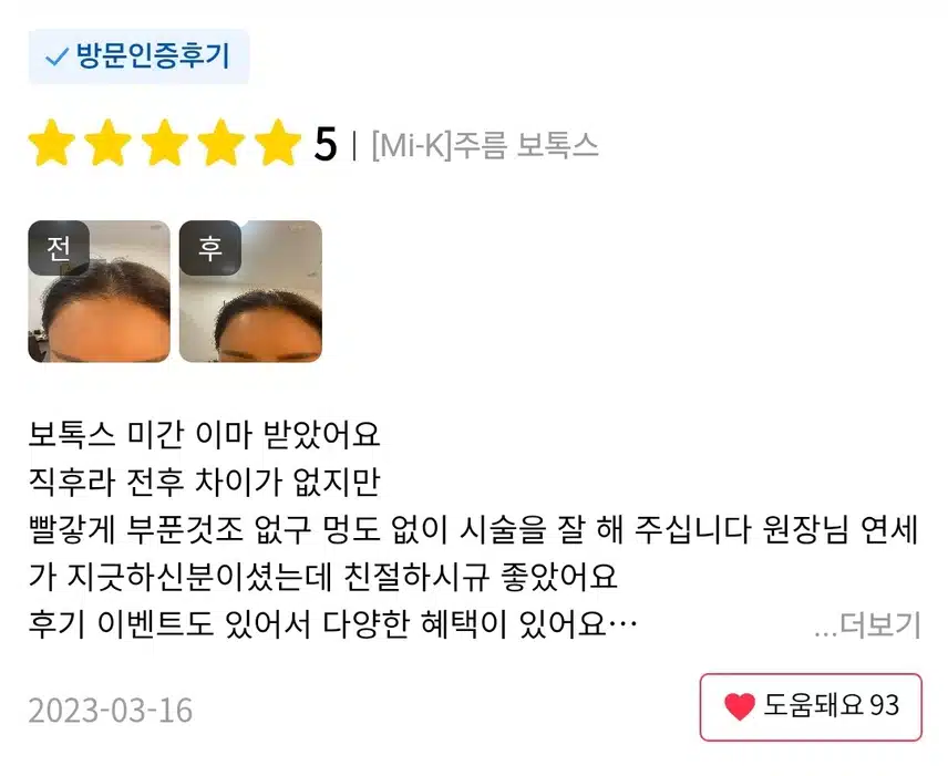 서초구 미케이의원 주름보톡스 후기추천