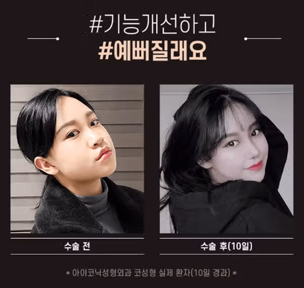 서울 강남구 비염개선, 기능코성형 아이코닉 후기 추천
