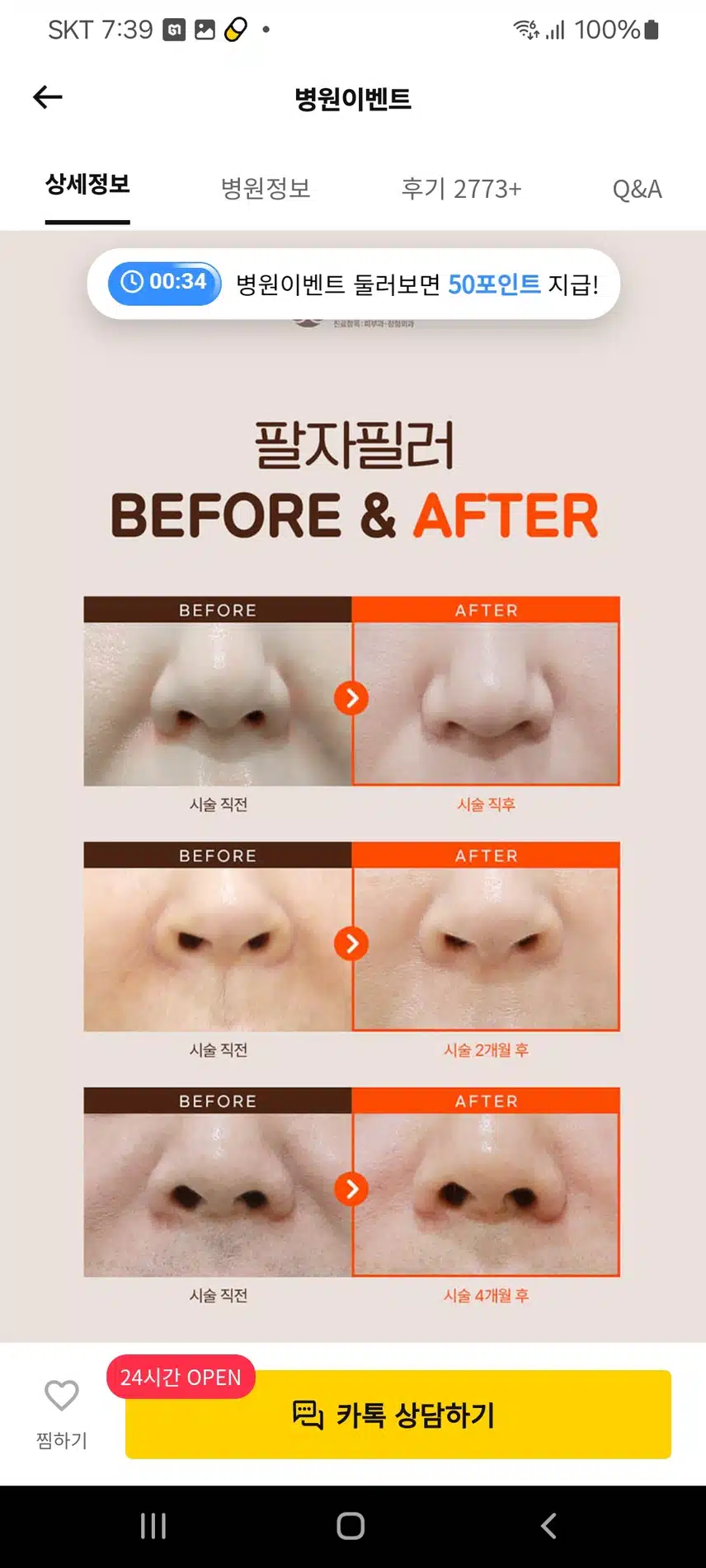서초구 미케이의원 팔자필러 3.8만원 좋아요