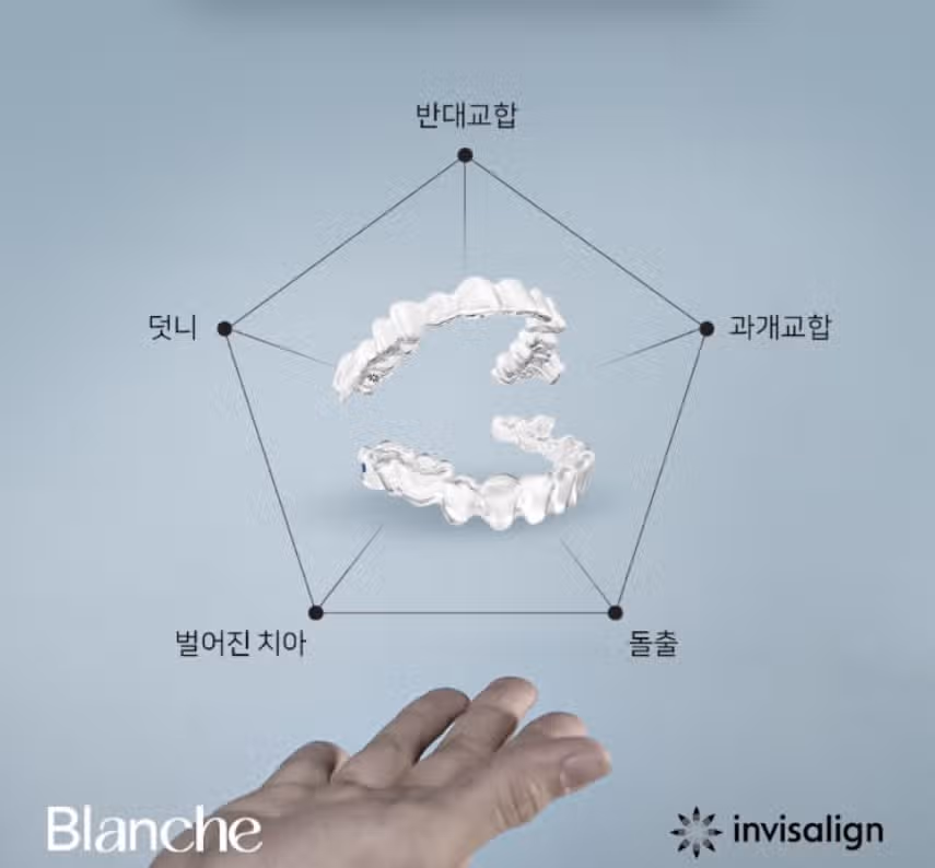 서울 서초구 블랑쉬 치과-블랑쉬 투명교정 인비절라인 99만원 후기 추천합니다