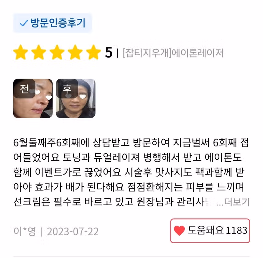 서초구 미케이의원 에이톤 레이져 9.9 만원 후기 추천