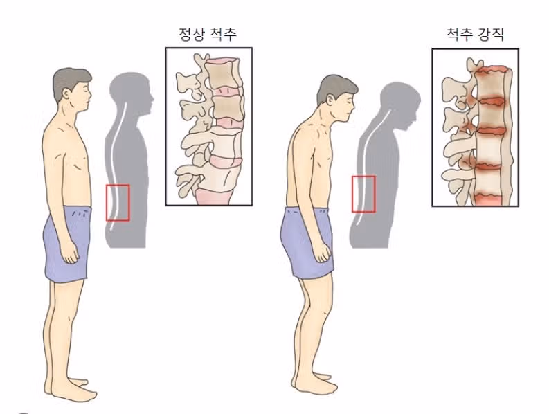 (질문)염증성 척추 통증은 그냥 두어도 자연 치유가 될까요?