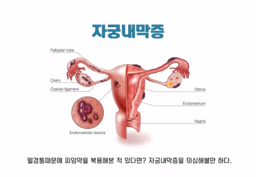 고민)결혼을 앞둔 딸 자궁내막증후 임신도 가능할까요