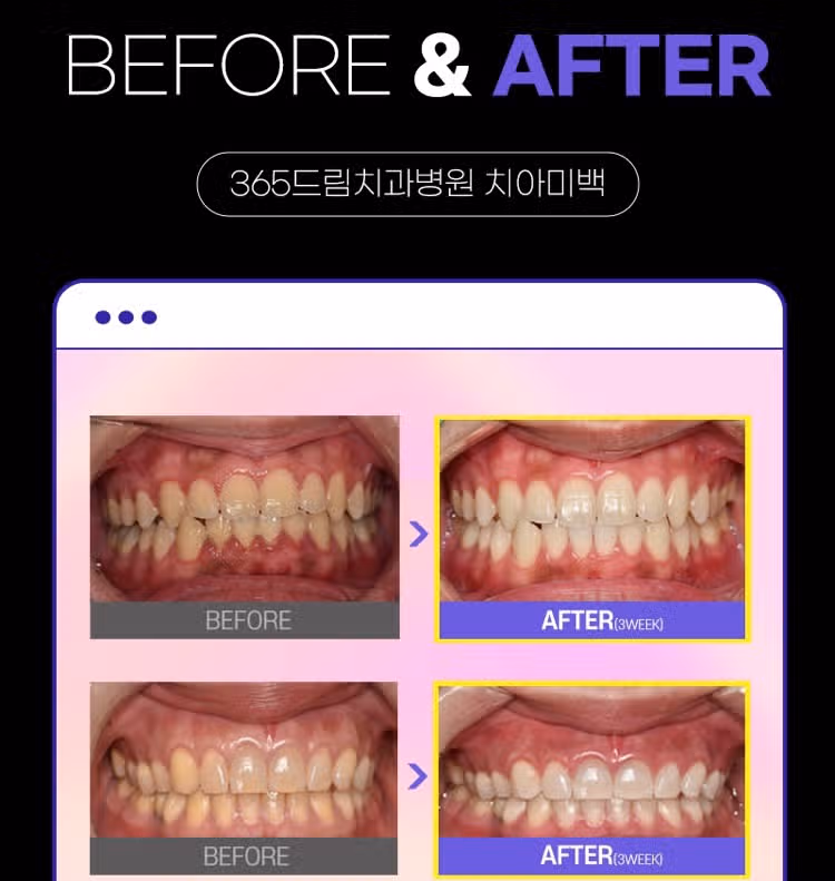 부산 365드림치과 치아미백 후기 추천해요👍
