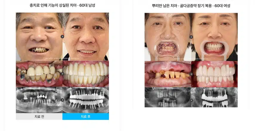 서초구 하루플란트치과 임플란트 개당 29만원/전체 290만원 후기 추천합니다