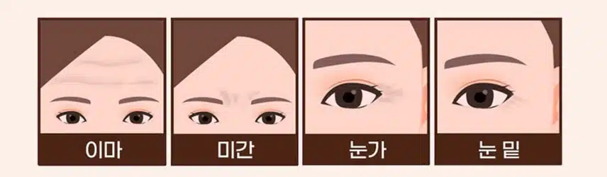 서초구 미케이의원 주름보톡스2.5만원 후기 추천해요~