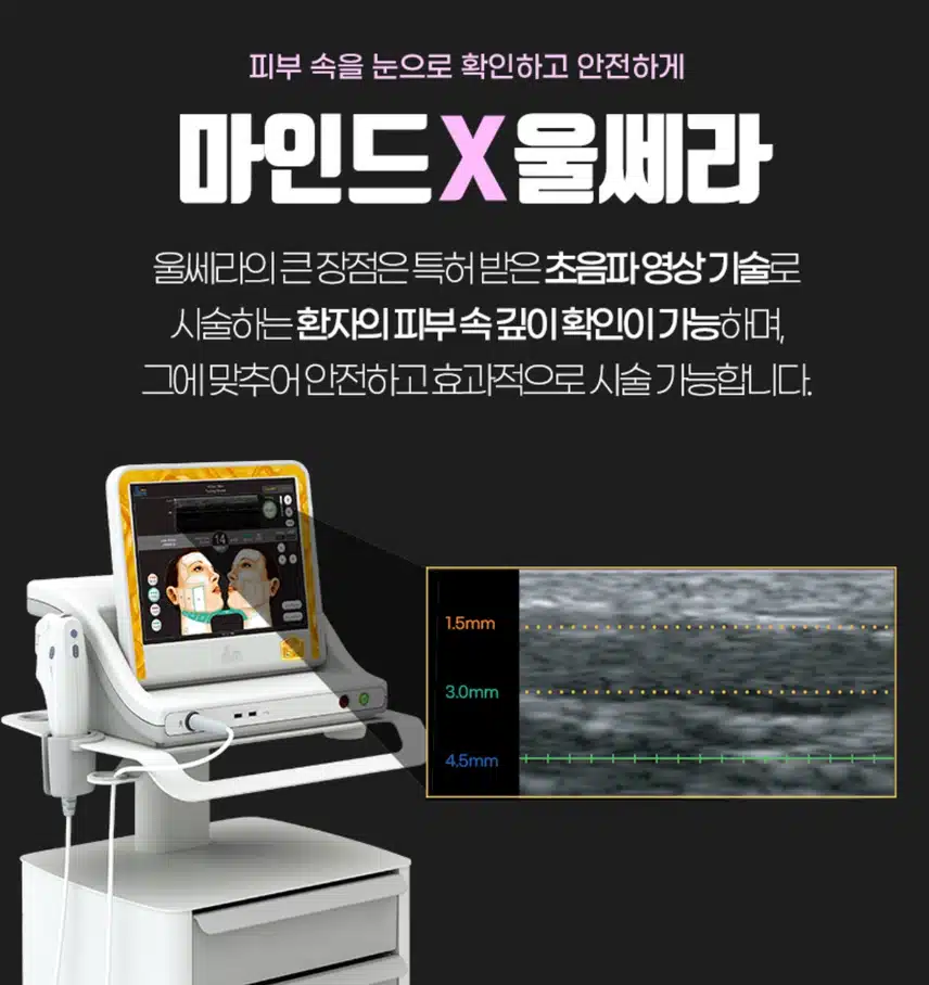 서초구 마인드성형외과 마인드 X 울쎄라리프팅 30만원 후기