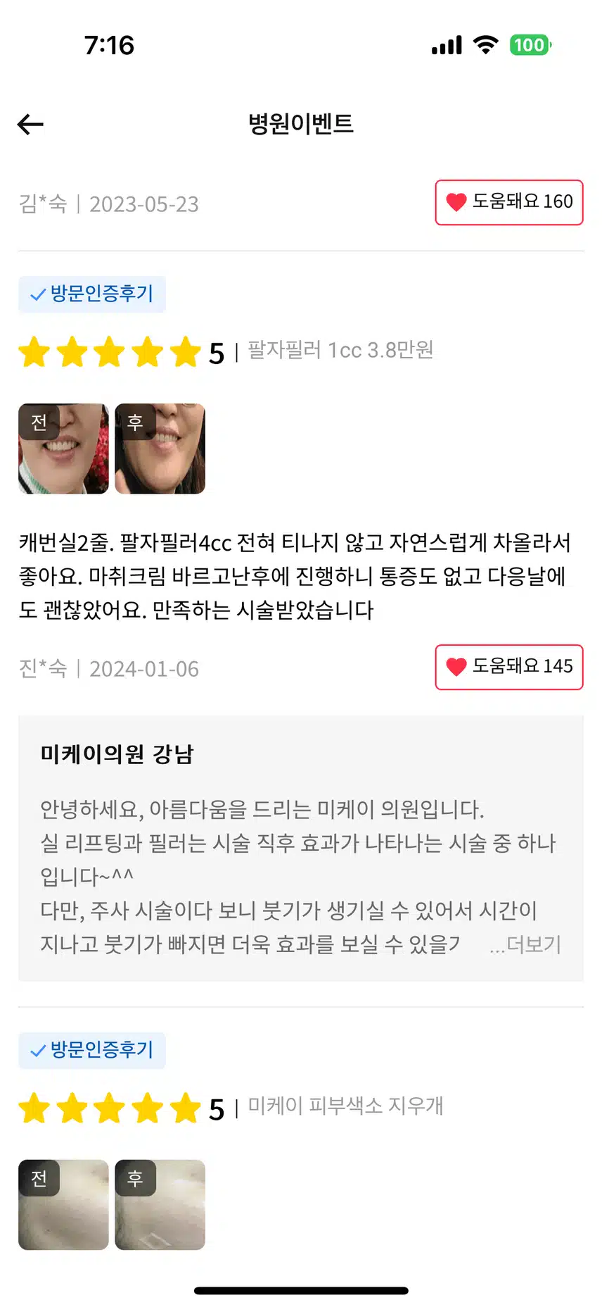 미케이 강남 팔자필러 1cc 3.8만원