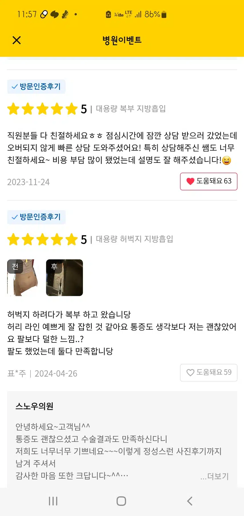 강남 대용량 복부지방흡입 55만원 후기입니당😃👍👍