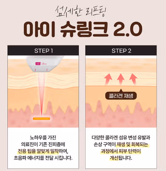 서울시 서초구 슈링크 유니버스 아이전용 후기