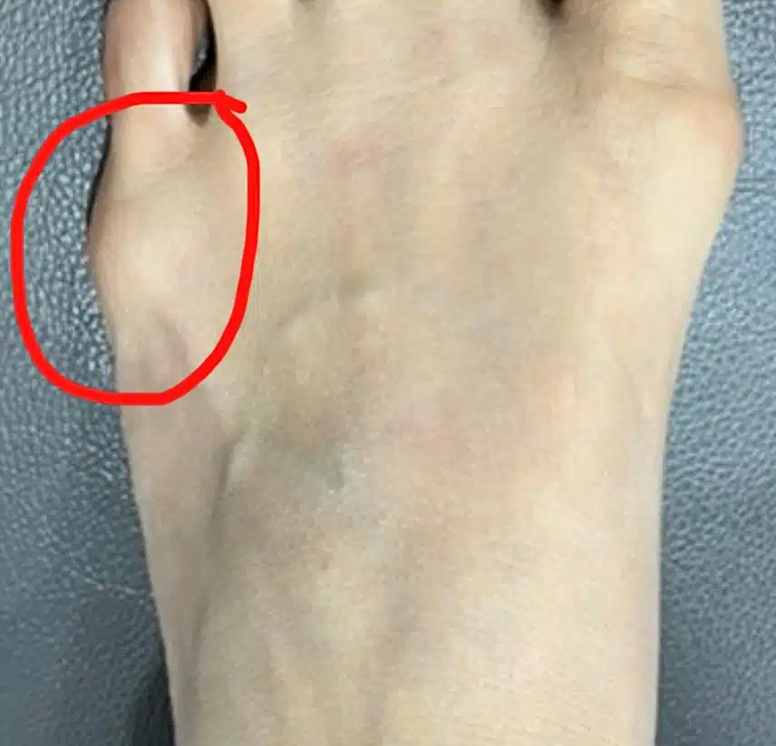 새끼발가락 밑에 뼈가 튀어나오고 아픈 건 뭘까요?