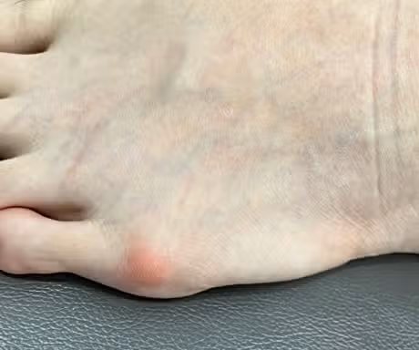 새끼발가락 밑에 뼈가 튀어나오고 아픈 건 뭘까요?