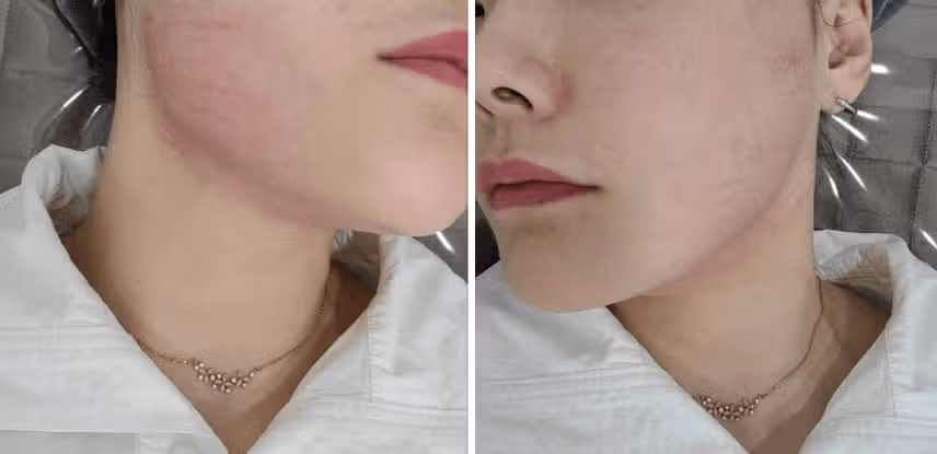 건대인모드 Fx 풀페이스 컷슬린 인젝션 이중턱뿌시기