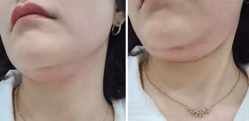 건대인모드 Fx 풀페이스 컷슬린 인젝션 이중턱뿌시기