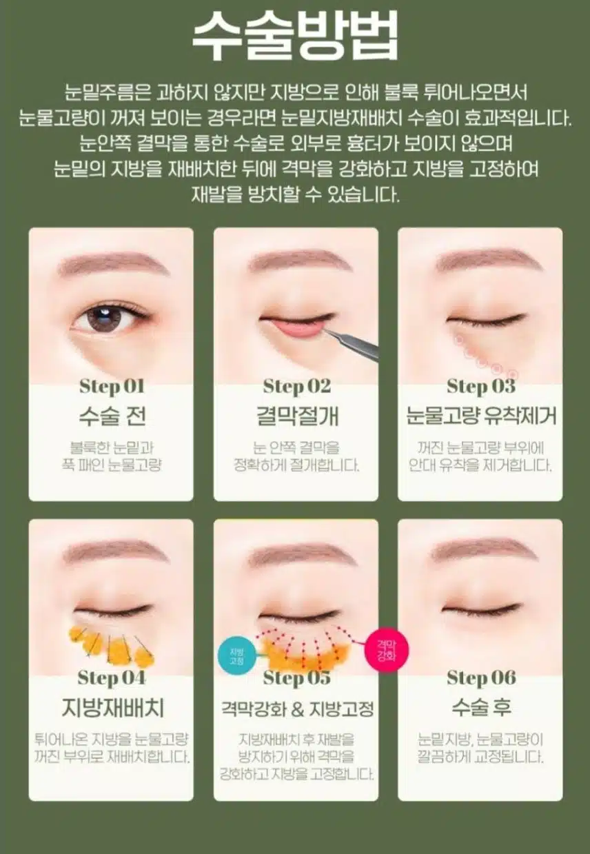 하안검 또는 눈밑지방재배치 시술 받고 싶어요