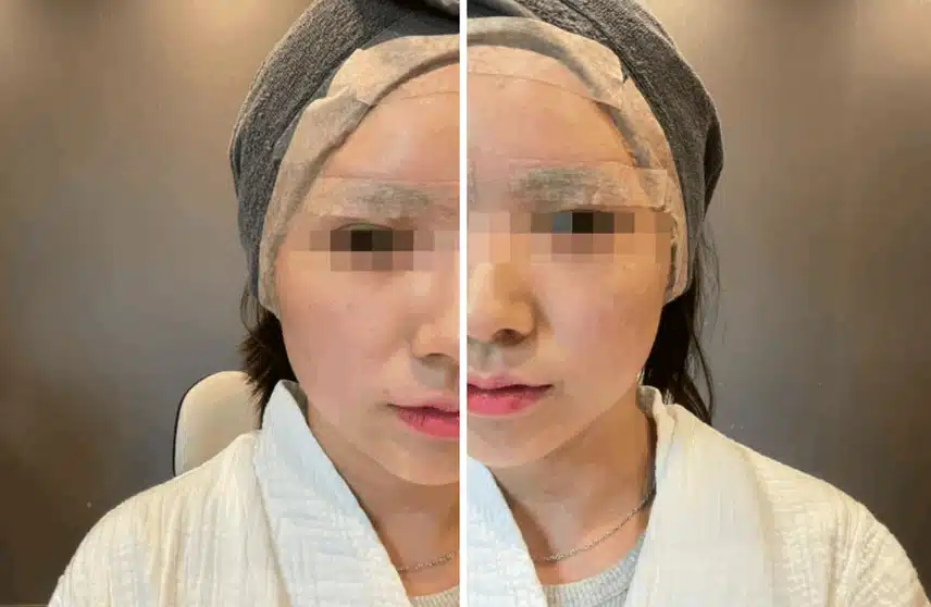역삼역피부과 티타늄리프팅 잘하는 병원
