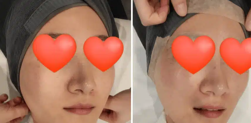 강남피부과에서 요즘 핫한 티타늄리프팅 받고 온 후기