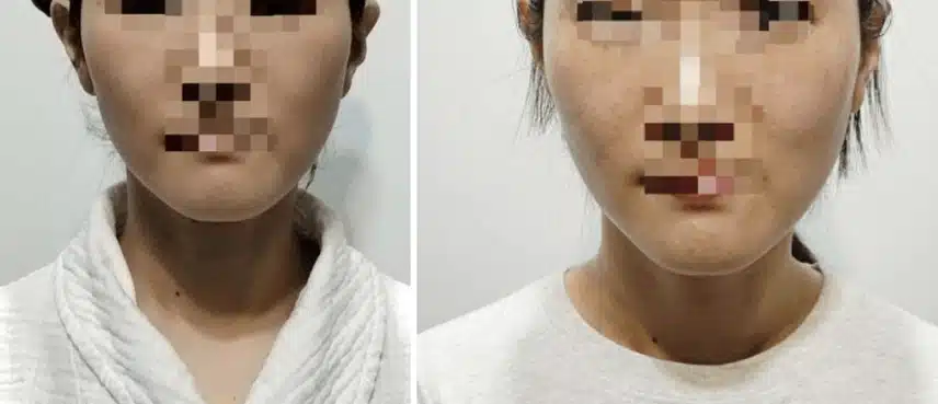 강남피부과에서 요즘 핫한 티타늄리프팅 받고 온 후기