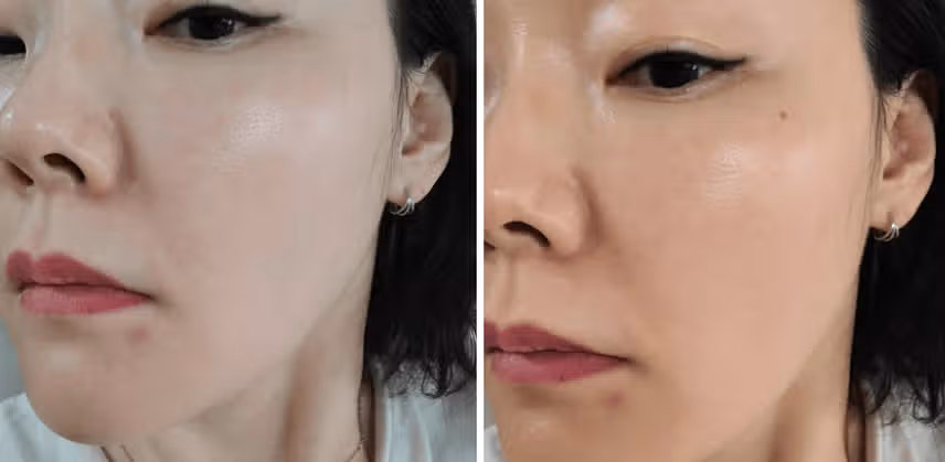 자양역피부과 모공관리 건대스킨보톡스 맛집