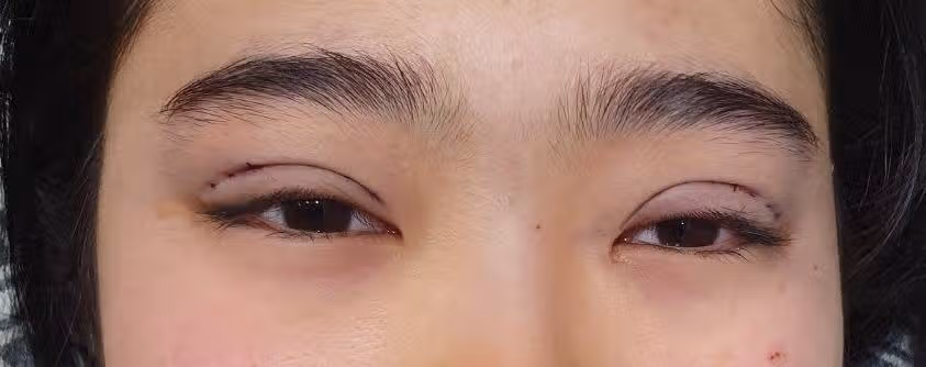 답답한 눈! 시원하게 찝었어요~