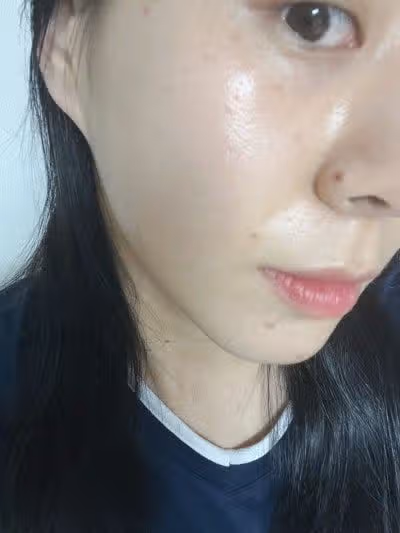 건대 잡티제거 레이저 후기 – 기미·점·편평사마귀까지 한 번에!