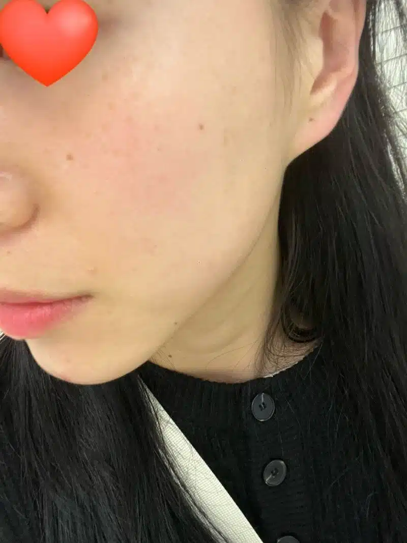 건대 잡티제거 레이저 후기 – 기미·점·편평사마귀까지 한 번에!