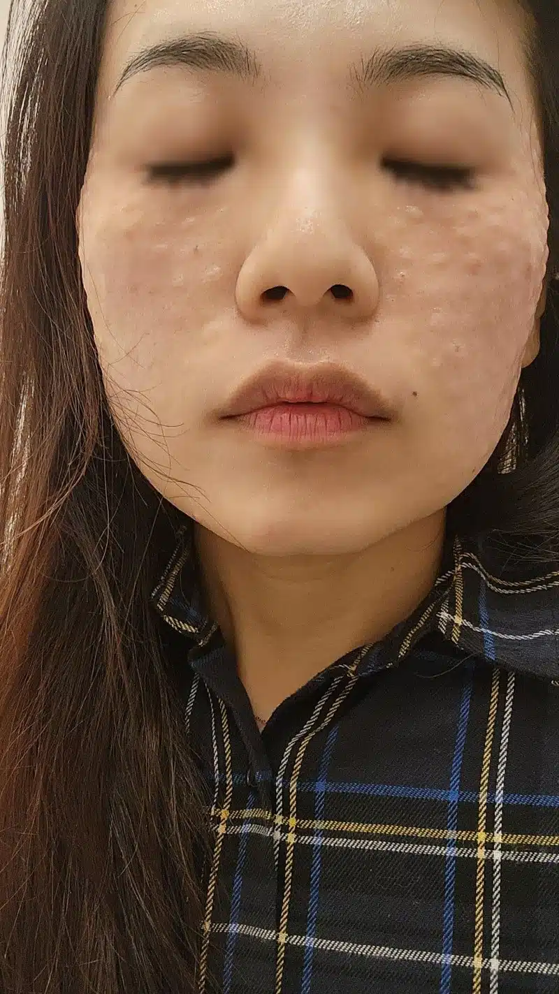 건대 리쥬란 HB 후기 – 자극 없는 수분·탄력 시술 체험기
