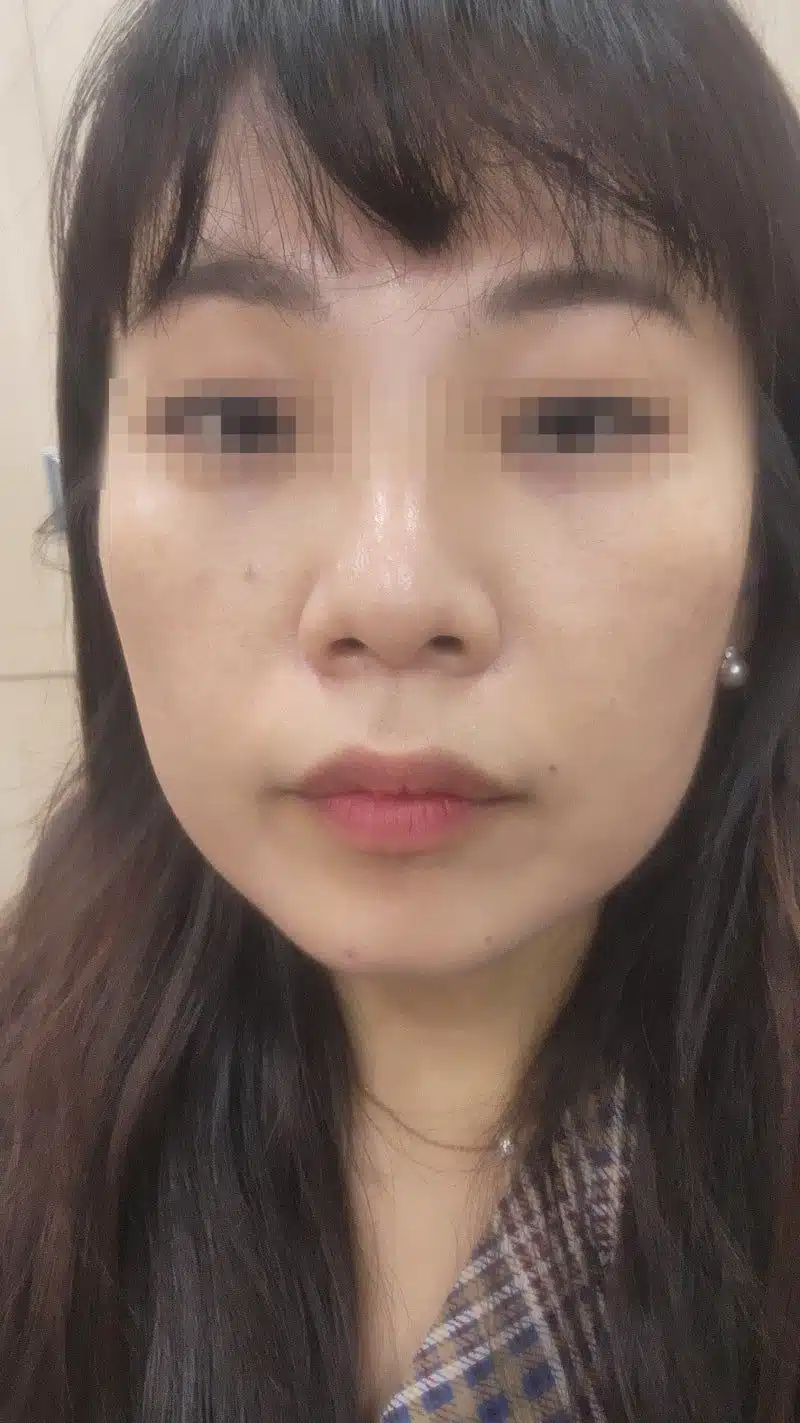 건대 리쥬란 HB 후기 – 자극 없는 수분·탄력 시술 체험기