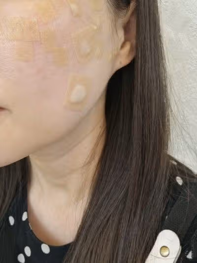 건대 클리어레이저 후기 – 진한 잡티까지 말끔히! 