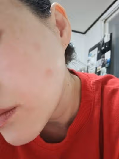 건대 클리어레이저 후기 – 진한 잡티까지 말끔히! 