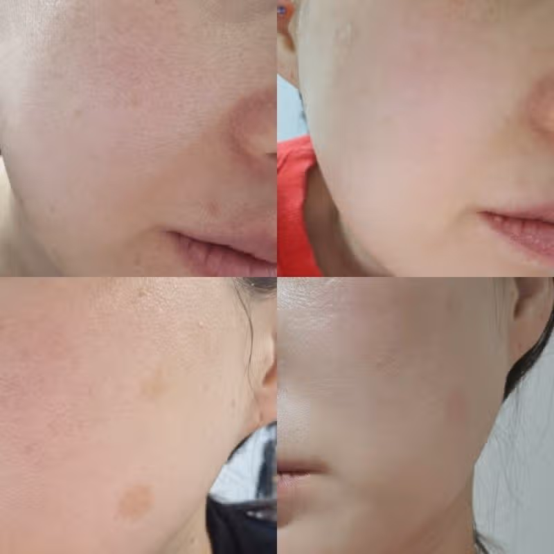 건대 클리어레이저 후기 – 진한 잡티까지 말끔히! 