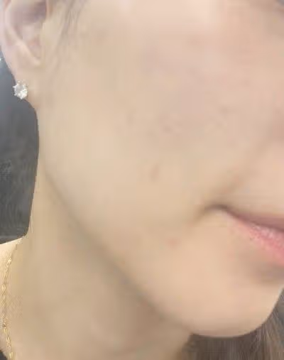 수원 스킨부스터 리얼 후기 – 리쥬란과 비교한 리즈네 2cc 시술 체험 (2주차 변화까지!)