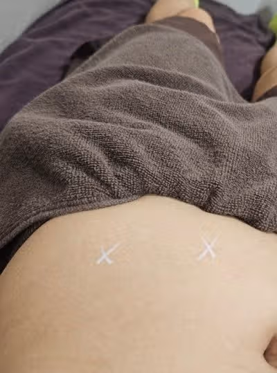 수원피부과에서 복부 지방분해주사 맞아본 리얼 후기