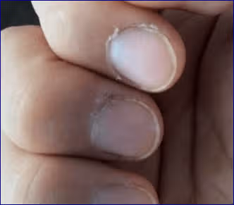 손톱주위 어떻게???