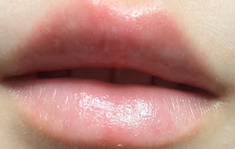 약 먹어도 그때뿐인 구순염 완치법 없을까요?