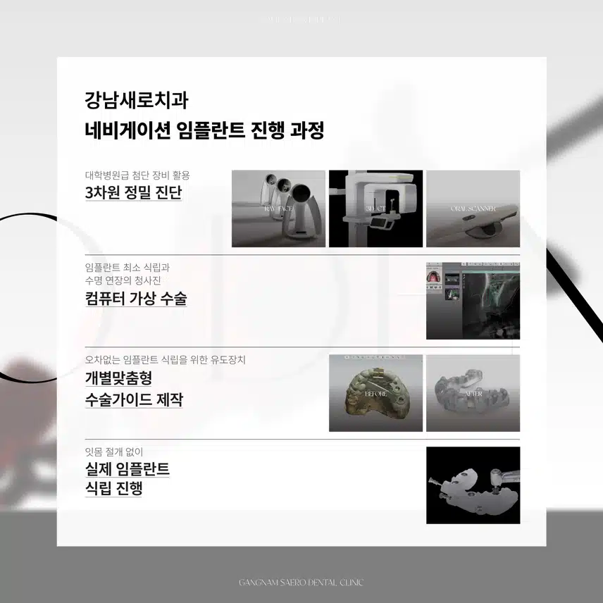임플란트 부작용/통증/기간 걱정된다면? - 네비게이션 임플란트