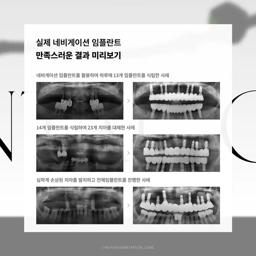 임플란트 부작용/통증/기간 걱정된다면? - 네비게이션 임플란트