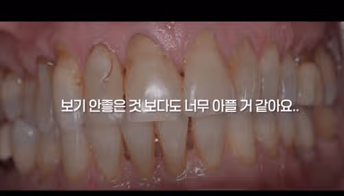 [건강칼럼] 잇몸 퇴축, 교정 때문일까? 원인과 예방법 정확히 알아보기