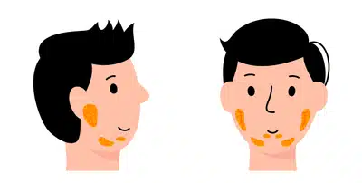 이하선염 증상 완벽 정리: 어른 볼거리 증상·전염·치료·약·원인까지 한눈에
