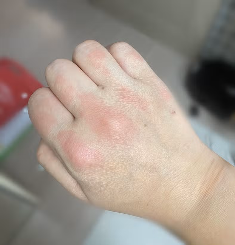 너무 가려운 콜린성 두드러기 해결방법 없을까요?